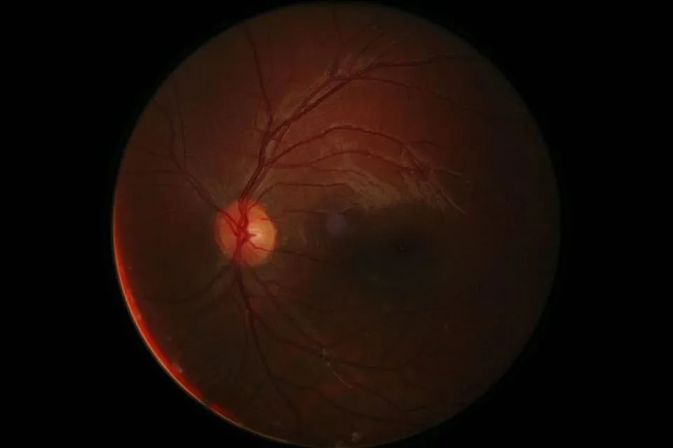 retinitis pigmentosa
